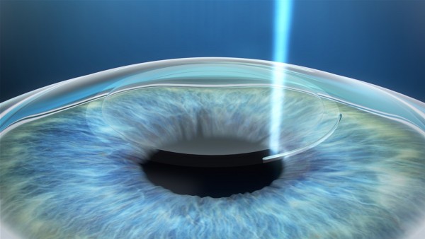 Лазерное лечение глаз при тонкой роговице.jpg